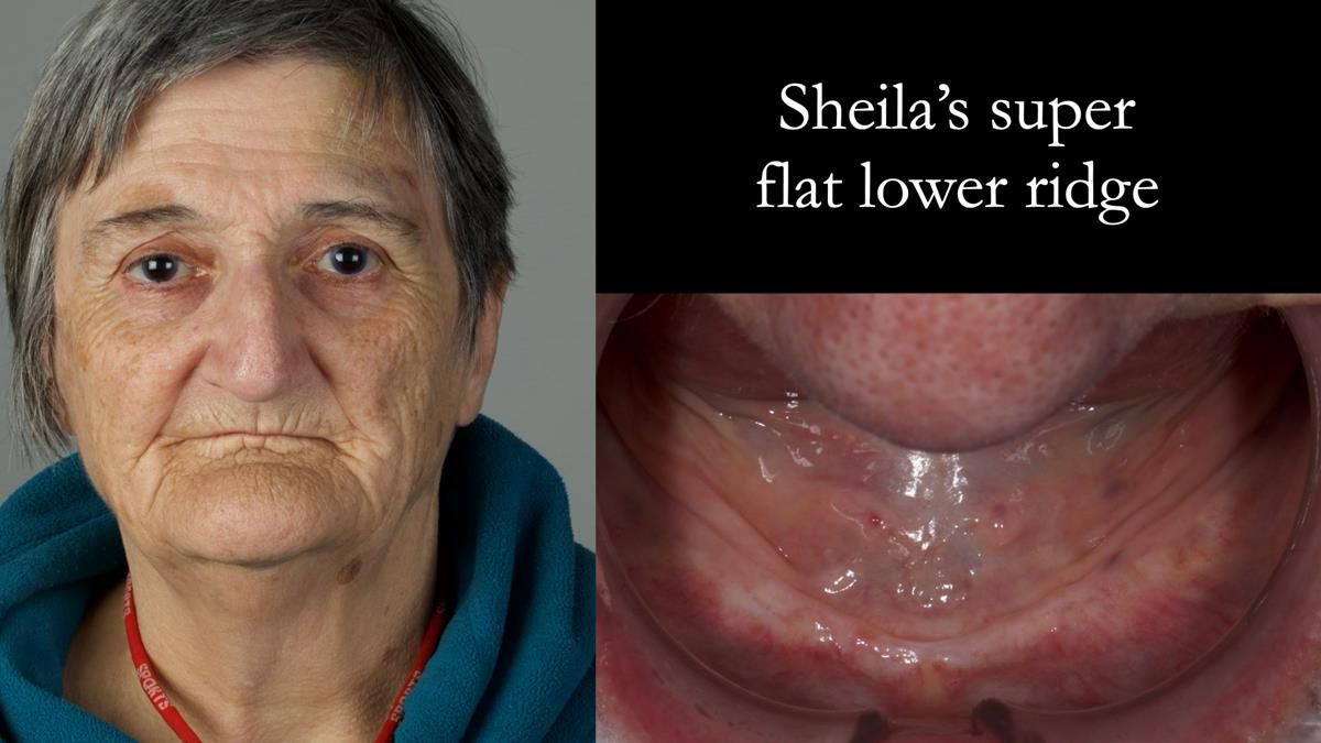 Newsletter 87 – Father Peter: A Partial Denture that needed Minor Miracle
