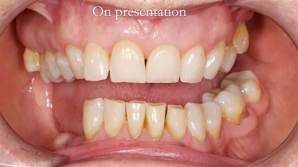 Finlay's Newsletter 61 provision of a lower unilateral free end saddle metal based partial denture for Joyce