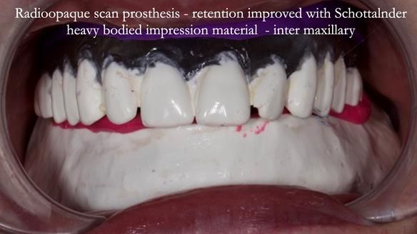 Replacing Madeline’s Complete denture FULL PROTOCOL