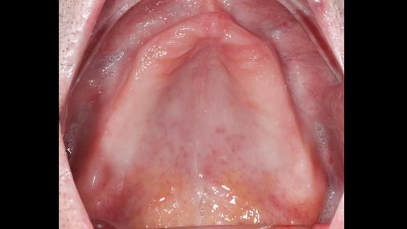 Newsletter 80 - Gordon’s dentures: the one case in 1,000 where my technique failed