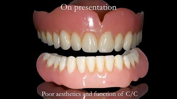 Newsletter 48 Mavis's Complete denture FULL PROTOCOL