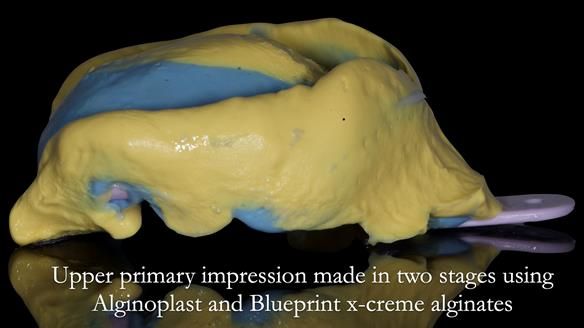 Newsletter 53 showing the making and fitting of ultra life-like dentures for Valena