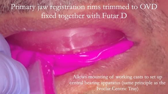 Finlay's Newsletter 62 provision of extractions and metal based complete dentures for Rafique
