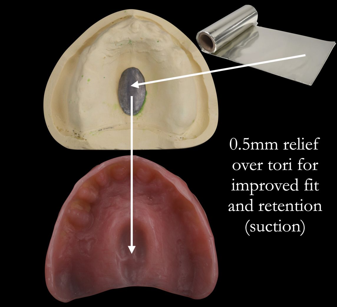 Maxillary Tori – complete dentures