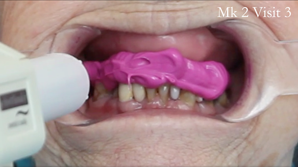 Figure 85 Central bearing apparatus fixed together with Futar D.