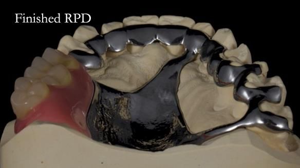 Finlay's Newsletter 64 case study - provision of a Kennedy class 2 metal based Scandinavian RPD for Ian