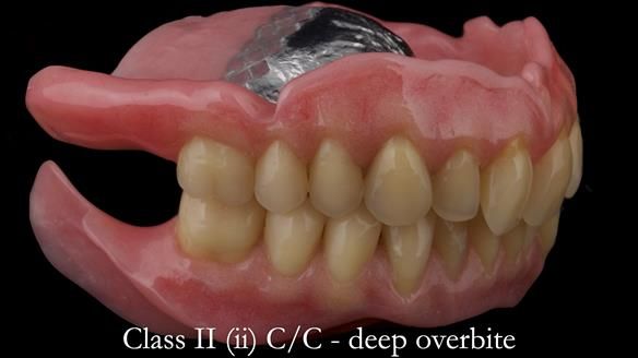 Complete denture Class II div 2 deep overbite Newsletter 39