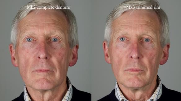 Newsletter 77: Jeremy’s case – immediate complete upper denture