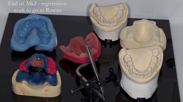 Newsletter 77: Jeremy’s case – immediate complete upper denture