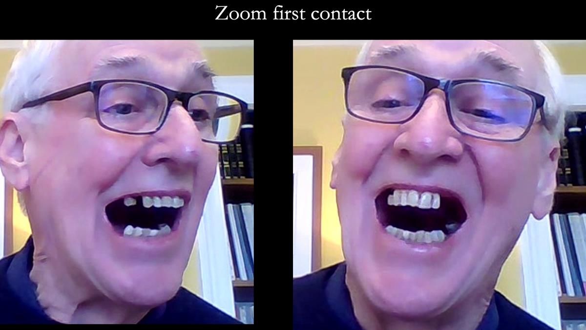 Newsletter 89 – Simon: A Challenging Kennedy Class II Division 1 Upper CoCr Partial Denture with a High Smile Line