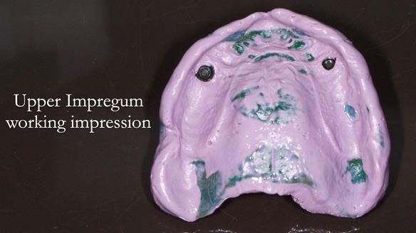 Newsletter 57 showcases the making and fitting process of implant-supported complete dentures for Alisdair