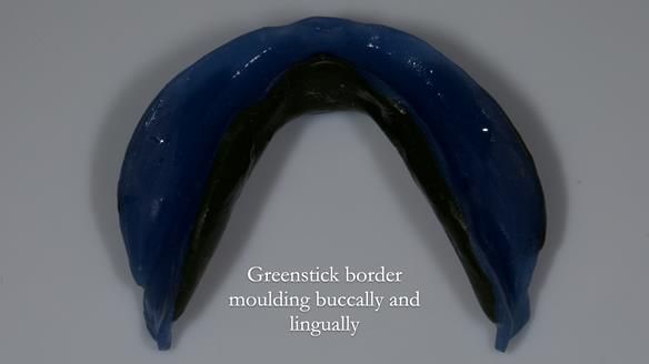 Newsletter 83: Sheila’s Complete Denture Success