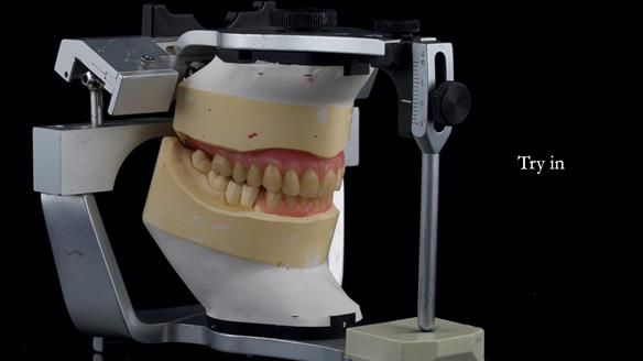 Newsletter 82 Mary - A complete upper and a one-tooth gasket denture