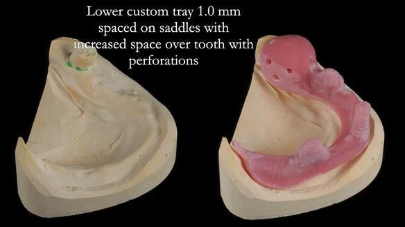 Finlay's Newsletter 59 Ultra hard partial dentures made for Gill