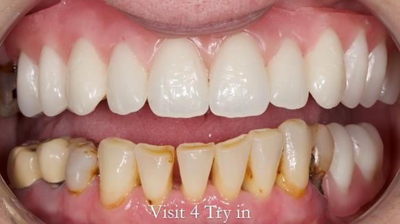 Newsletter 52 Managing Jo’s failing dentition with extractions and Mk 1/Mk 2 complete upper dentures and lower partial dentures FULL PROTOCOL