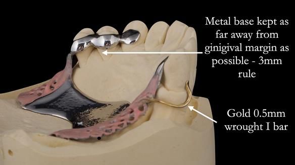 Solving Sue's failed implants with metal based RPD - full protocol Newsletter 43