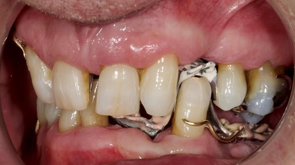 Newsletter 86 Peter the Architect — precision removable partial dentures case study