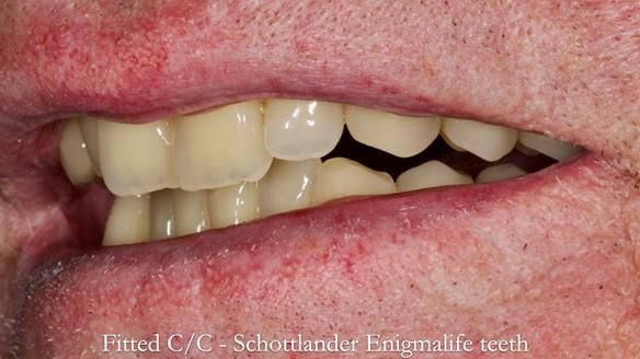 Complete denture Class II div 2 deep overbite Newsletter 39