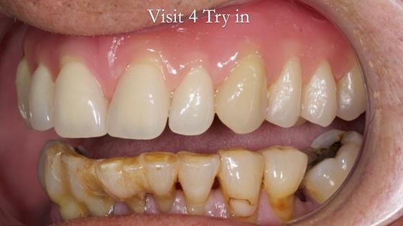 Newsletter 54 case presentation upper complete denture and lower Scandinavian designed hygienic partial denture for David