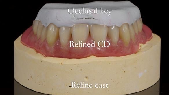 Finlay's Newsletter 62 provision of extractions and metal based complete dentures for Rafique