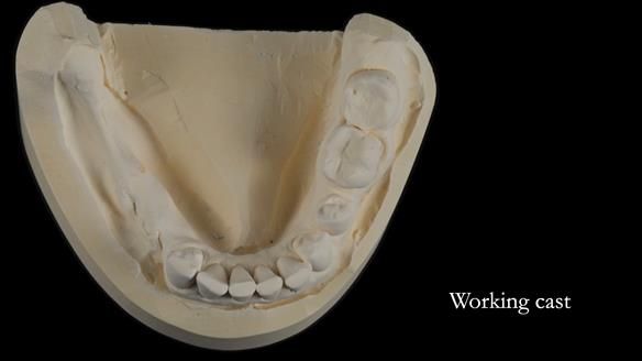 Finlay's Newsletter 61 provision of a lower unilateral free end saddle metal based partial denture for Joyce