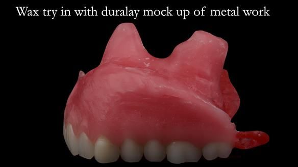 Upper metal base partial denture/occlusal stabilisation splint/obturator - full protocol