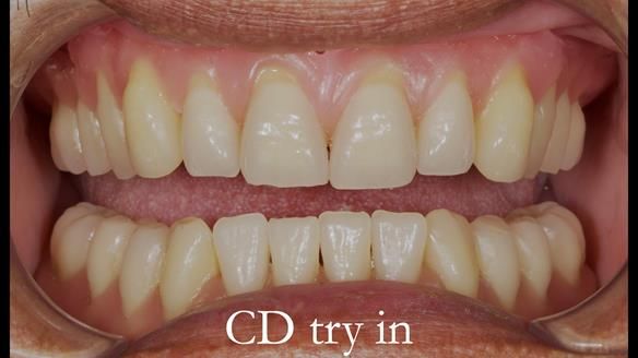 Finlay's Newsletter 62 provision of extractions and metal based complete dentures for Rafique