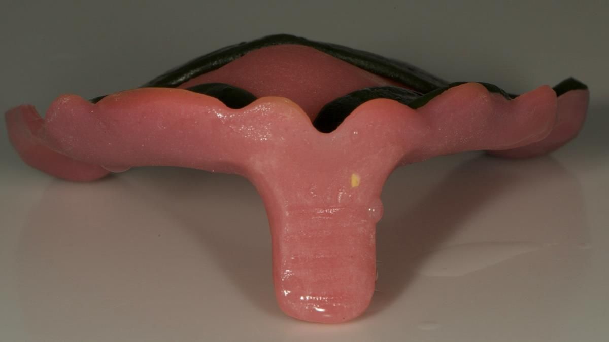 Newsletter 87 – Father Peter: A Partial Denture that needed Minor Miracle