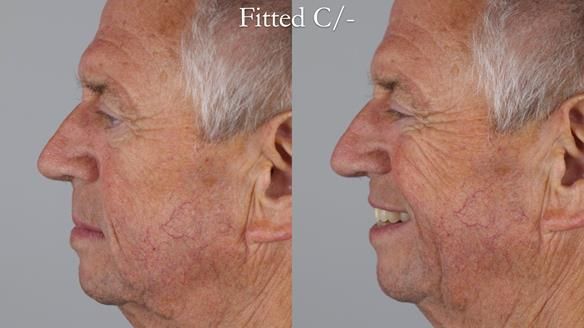 Newsletter 54 case presentation upper complete denture and lower Scandinavian designed hygienic partial denture for David