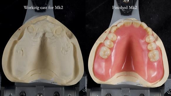 Newsletter 77: Jeremy’s case – immediate complete upper denture