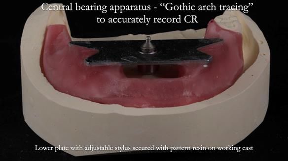 Finlay's Newsletter 59 Ultra hard partial dentures made for Gill