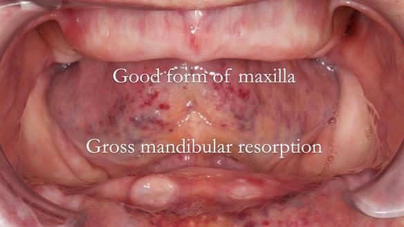 Newsletter 50 Special edition Complete Dentures FULL PROTOCOL