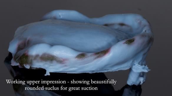 Newsletter 83: Sheila’s Complete Denture Success