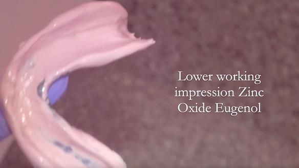 Finlay's Newsletter 62 provision of extractions and metal based complete dentures for Rafique