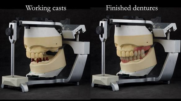 Newsletter 76: Jackie’s case – Telescopic overdenture & precision RPD (the tricky truth!)