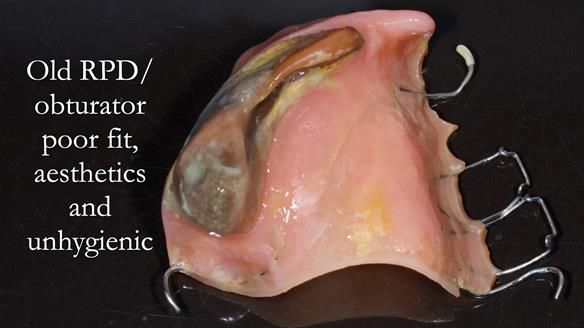 Upper metal base partial denture/occlusal stabilisation splint/obturator - full protocol