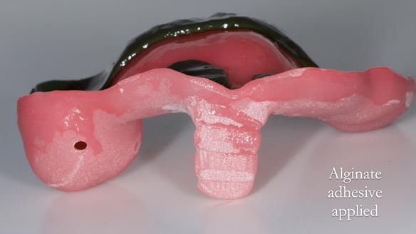 Newsletter 52 Managing Jo’s failing dentition with extractions and Mk 1/Mk 2 complete upper dentures and lower partial dentures FULL PROTOCOL