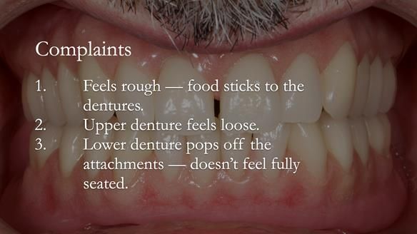 Newsletter 78: What do Clark Gable and a Locator® overdenture have in common?