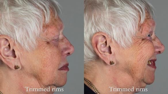 Finlay's Newsletter 59 Ultra hard partial dentures made for Gill