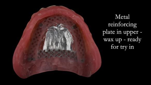 Wax try in. Reinforcement to the opposing dentures is also crucial to reduced breakages