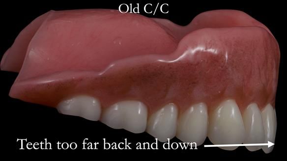 Newsletter 53 showing the making and fitting of ultra life-like dentures for Valena