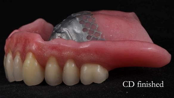 Finlay's Newsletter 62 provision of extractions and metal based complete dentures for Rafique