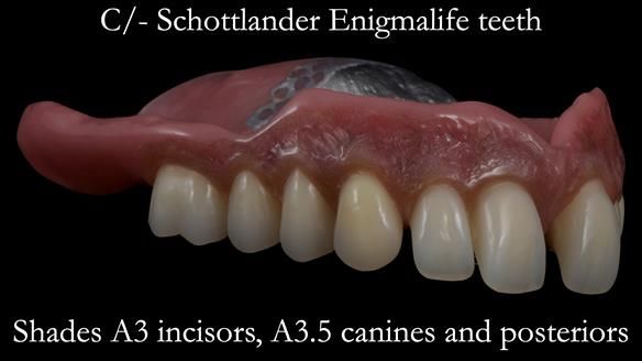 Newsletter 53 showing the making and fitting of ultra life-like dentures for Valena