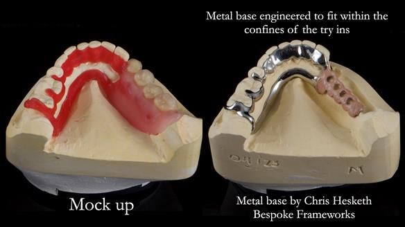 Finlay's Newsletter 61 provision of a lower unilateral free end saddle metal based partial denture for Joyce