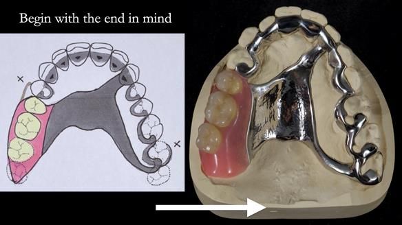 Finlay's Newsletter 64 case study - provision of a Kennedy class 2 metal based Scandinavian RPD for Ian