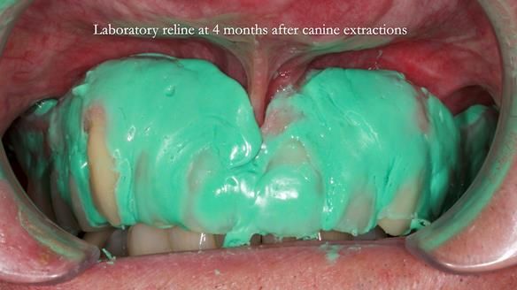 Newsletter 77: Jeremy’s case – immediate complete upper denture