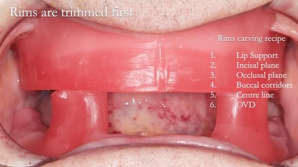 Newsletter 50 Special edition Complete Dentures FULL PROTOCOL