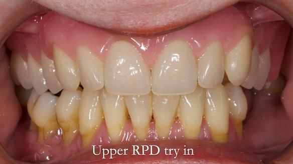 Finlay's Newsletter 58 Gasket upper partial denture for Zoe