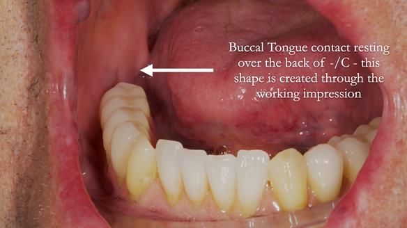 Newsletter 50 Special edition Complete Dentures FULL PROTOCOL