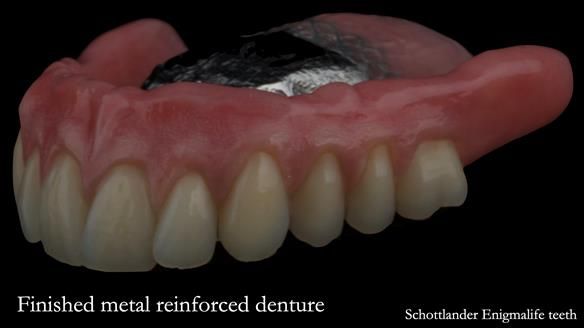 Finished upper denture